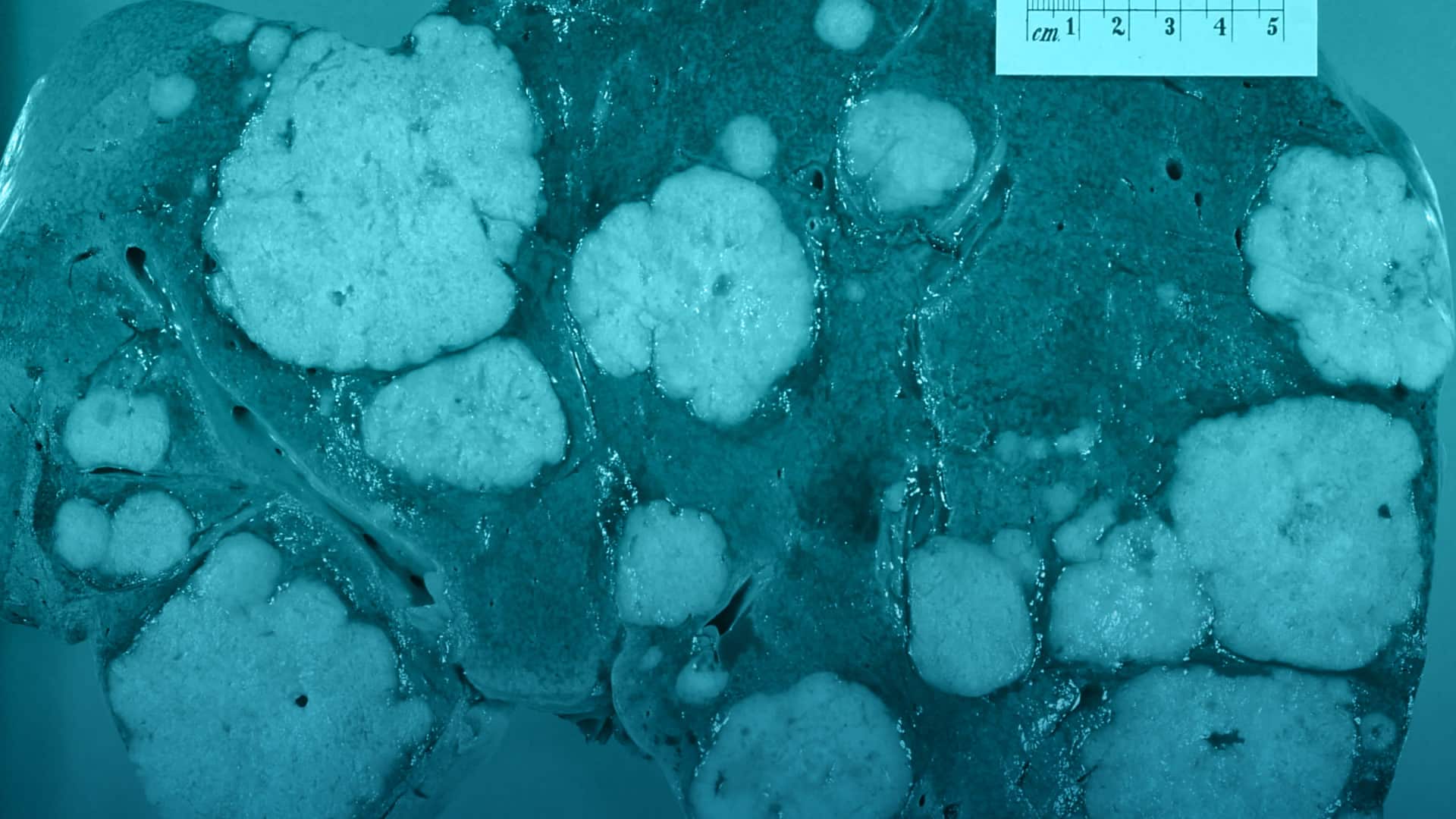 Perlas de radiación y microburbujas para que el tumor se muera de hambre