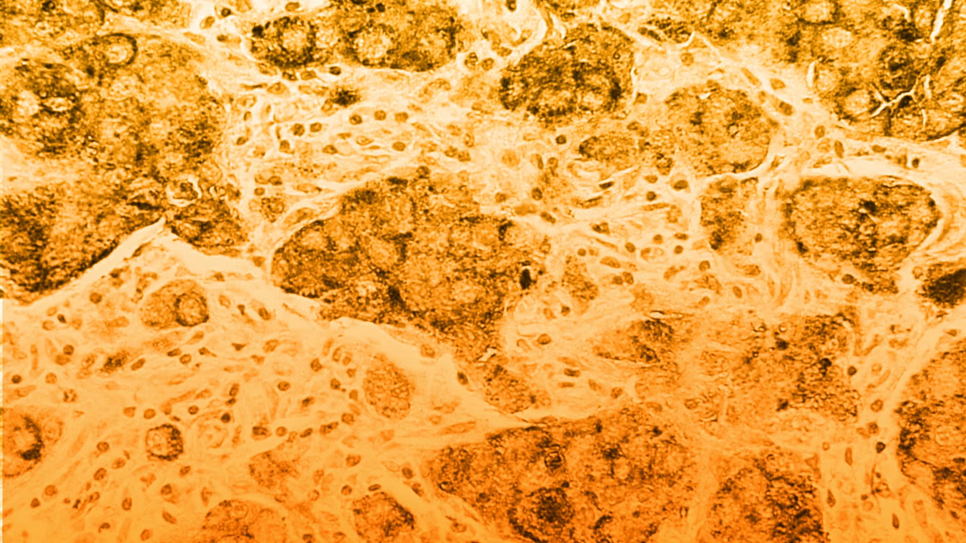 Ensayo clínico SD101 para que el sistema inmunológico destruya las células cancerosas