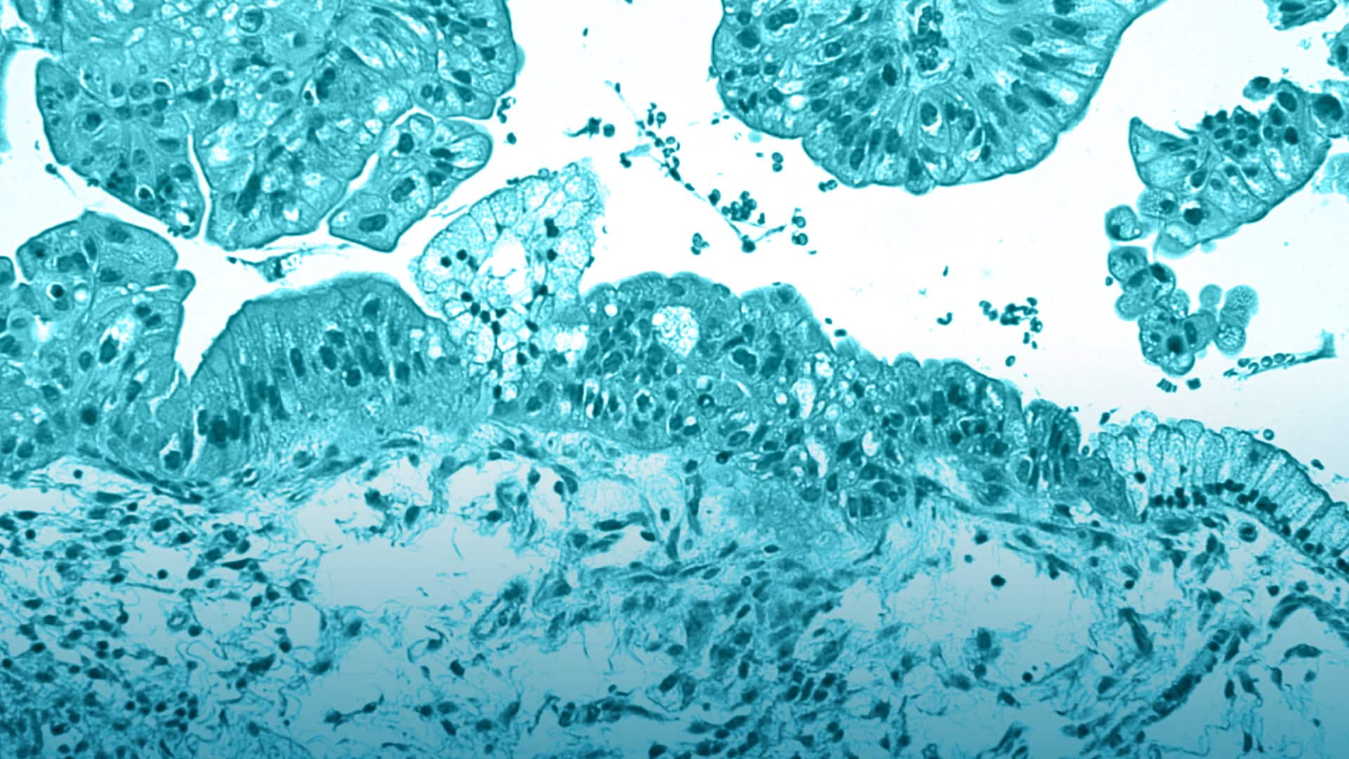 El cáncer de ovario es debido a las aspirinas
