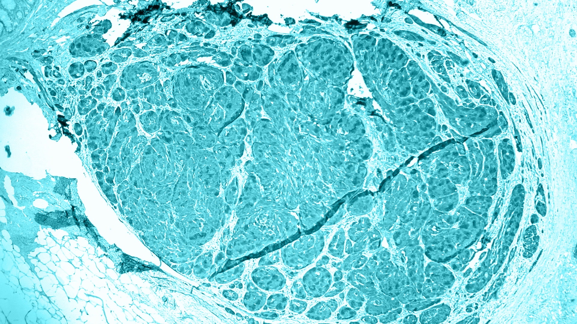 Método para extraer un tumor en el colon