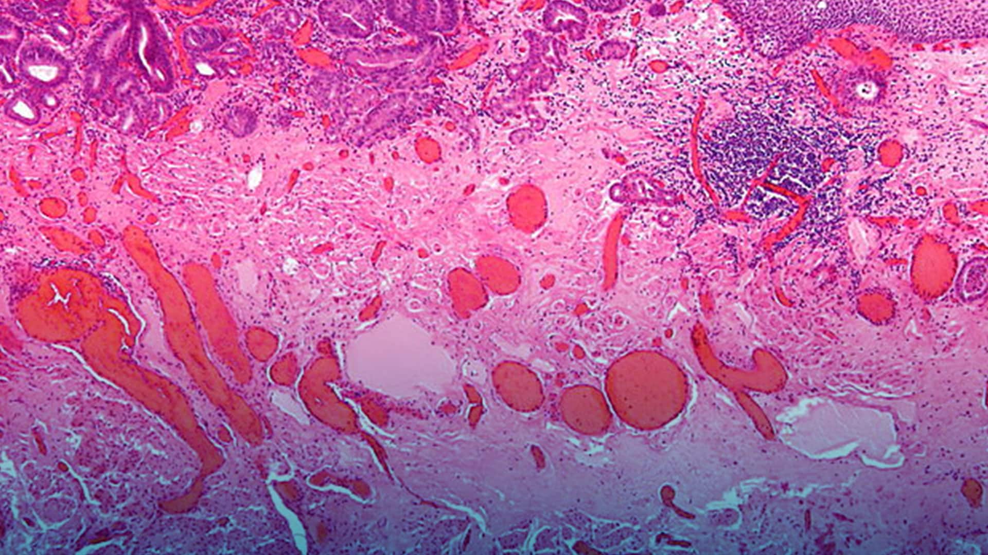Cáncer de esófago