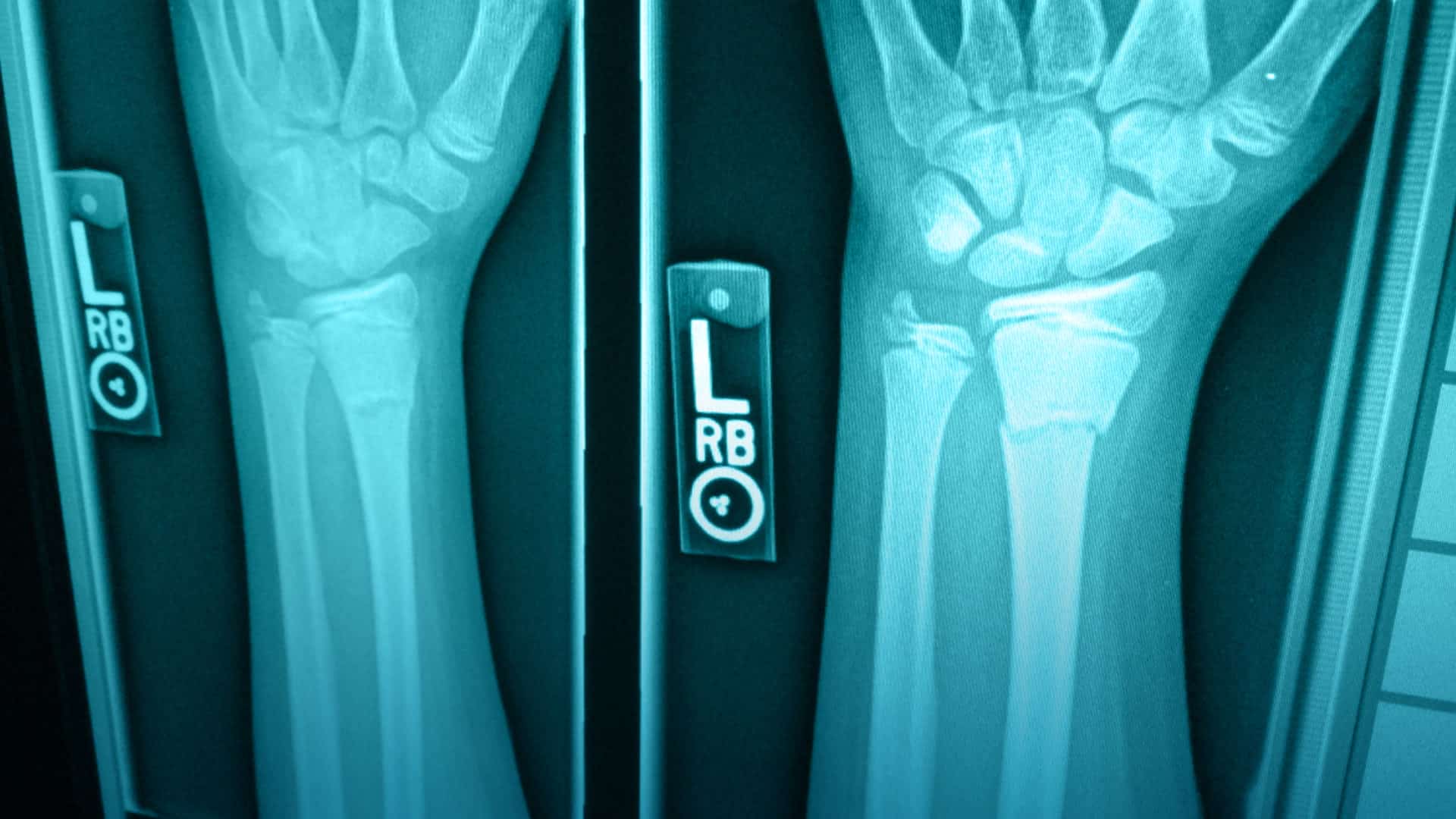 Osteoartritis