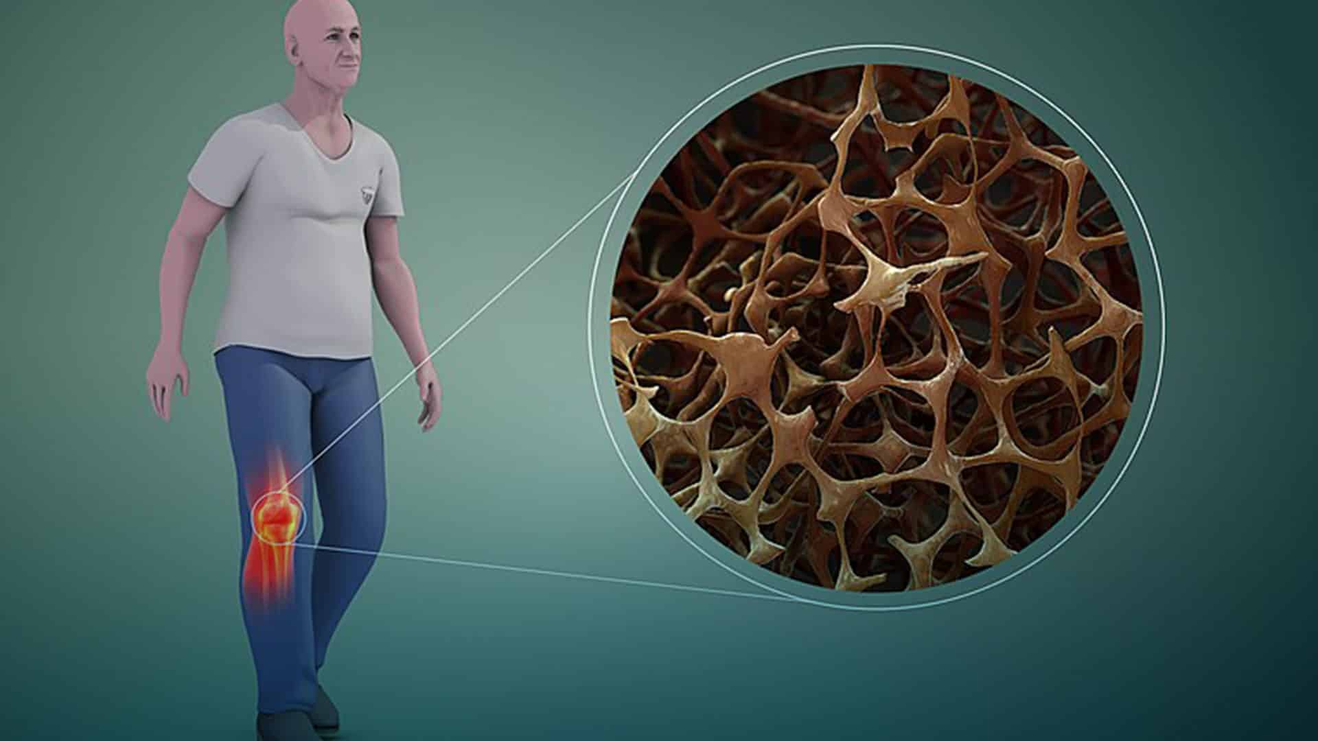 Osteopenia, ¿la pre-osteoporosis?