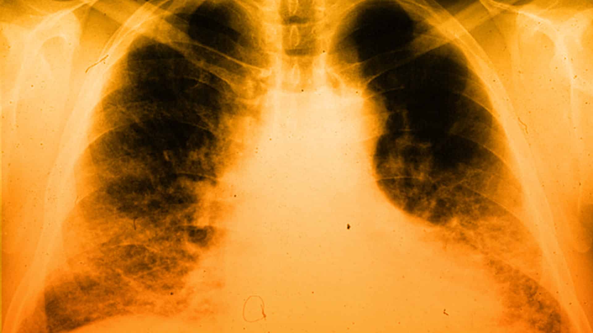 Esto es lo que debes saber sobre la fibrosis quística