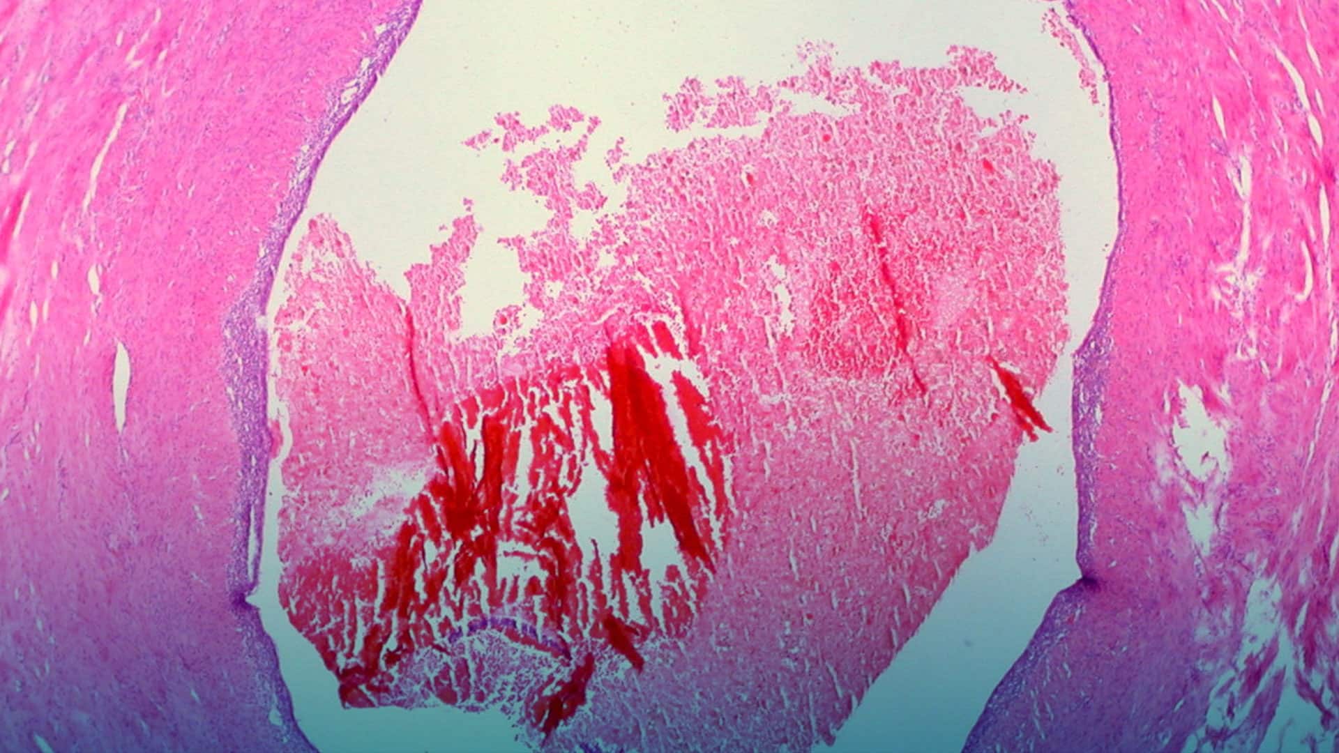 Endometriosis: causas y consecuencias