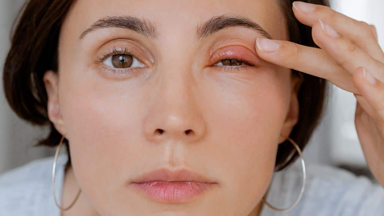 ¿Se te ha inflamado el párpado? Quizá es una infección periocular