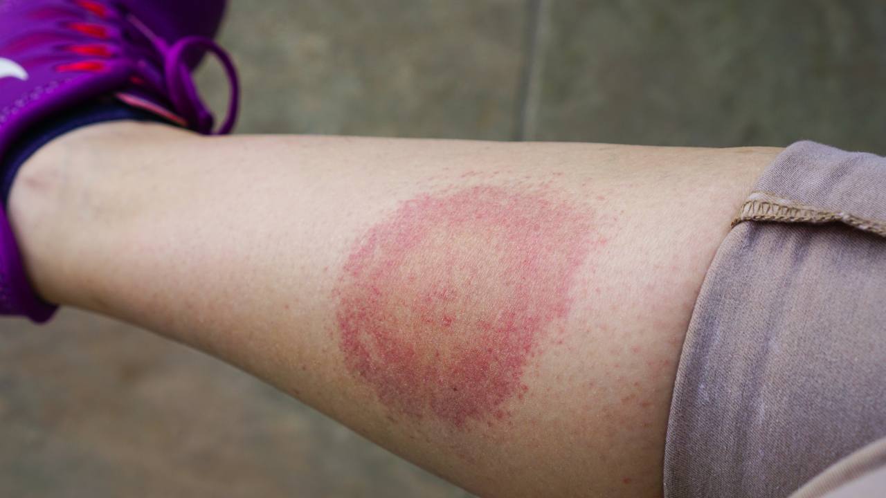 ¿Un granito que crece sin parar? Podría ser la enfermedad de Lyme