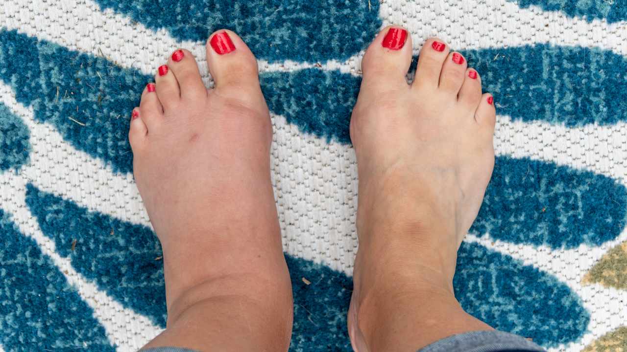 ¿Se te inflaman las piernas? Te contamos las causas