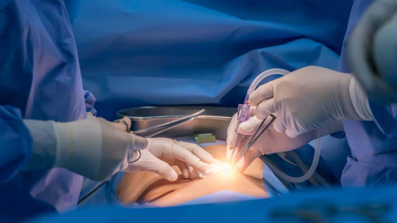 Reconstrucción abdominal: Más allá de la estética