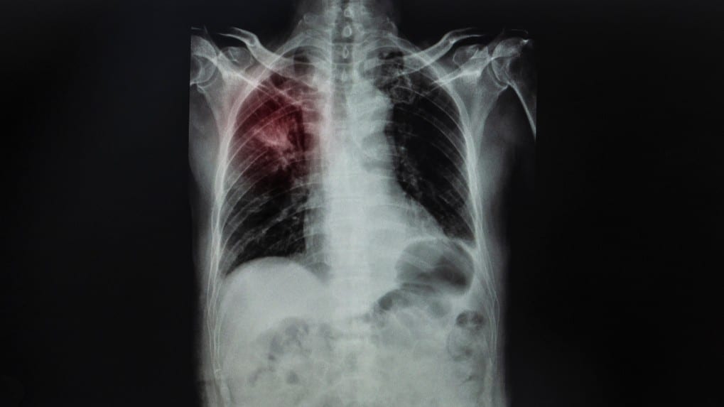 ¿Sabes lo que es la silicosis? Te lo explicamos