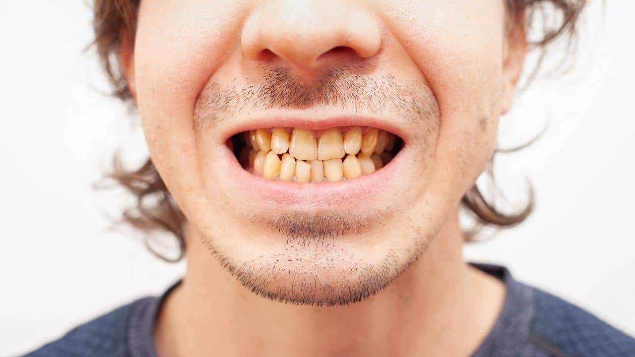 ¿Existe una conexión entre los dientes amarillos y los antibióticos?