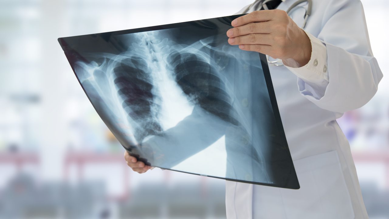 Tuberculosis: ¡no bajemos la guardia!