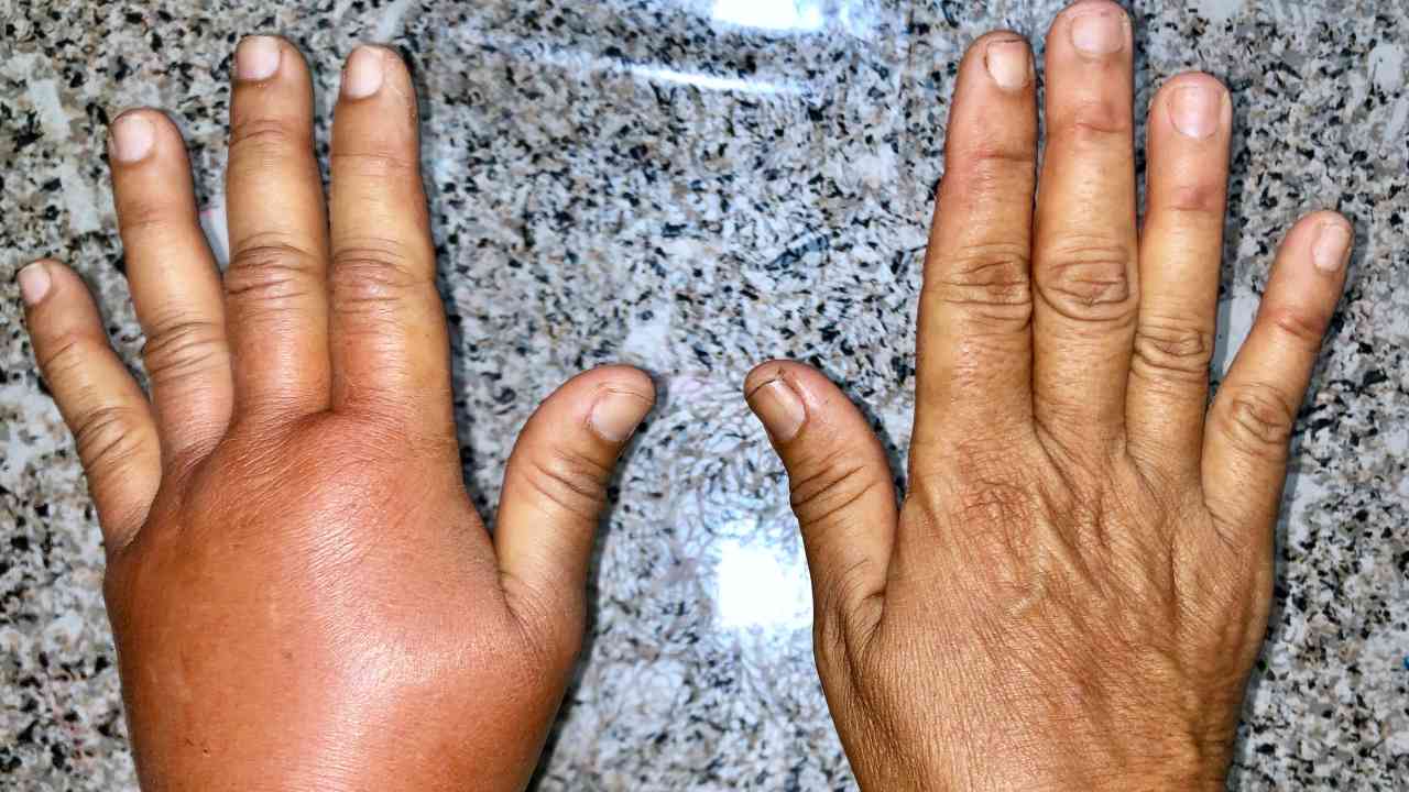 ¿Se te inflaman áreas del cuerpo sin razón? Podría ser angioedema