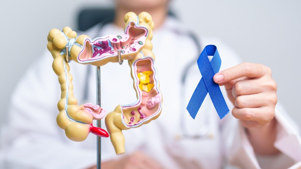 Aumento de cáncer en jóvenes menores de 50 años relacionado con factores genéticos y estilos de vida.
