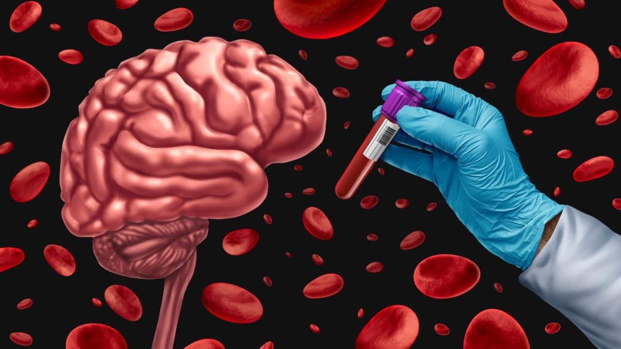 análisis de sangre Alzheimer