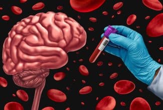 análisis de sangre Alzheimer