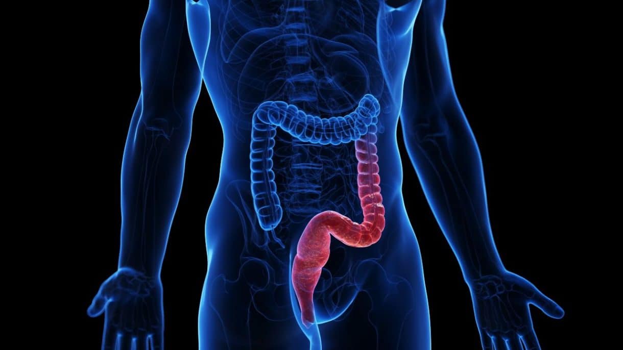 Colitis ulcerosa enfermedad inflamatoria intestinal que afecta el intestino grueso