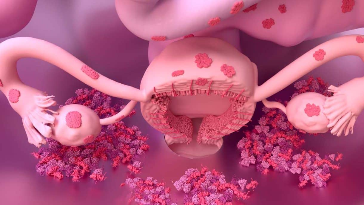 ilustración médica sobre endometriosis y sus síntomas