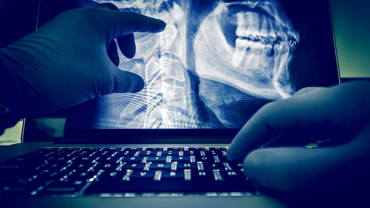 Radiografía mostrando cáncer de la pulpa dental en etapa inicial