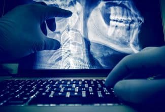 Radiografía mostrando cáncer de la pulpa dental en etapa inicial