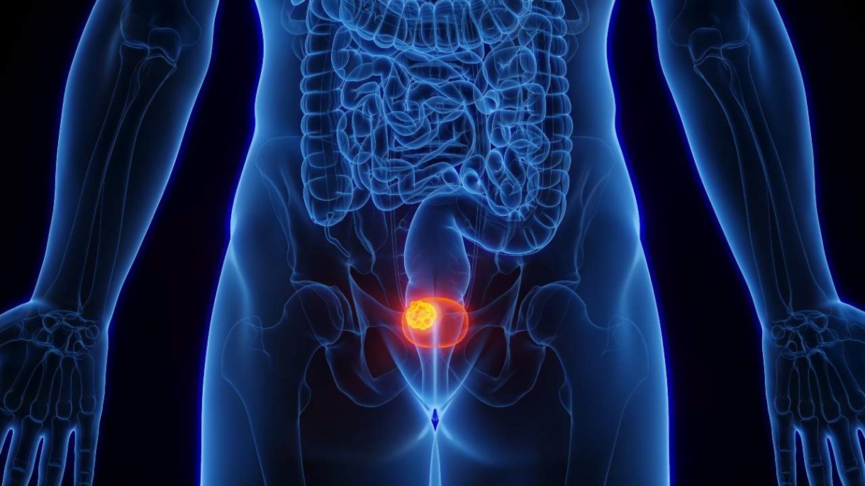 Ilustración de la vejiga humana resaltando un tumor vesical, usada para explicar los síntomas y la detección temprana del cáncer de vejiga.
