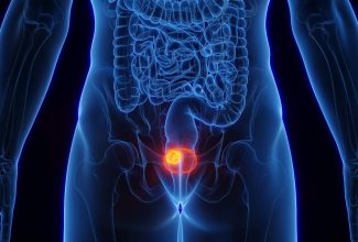 Ilustración de la vejiga humana resaltando un tumor vesical, usada para explicar los síntomas y la detección temprana del cáncer de vejiga.