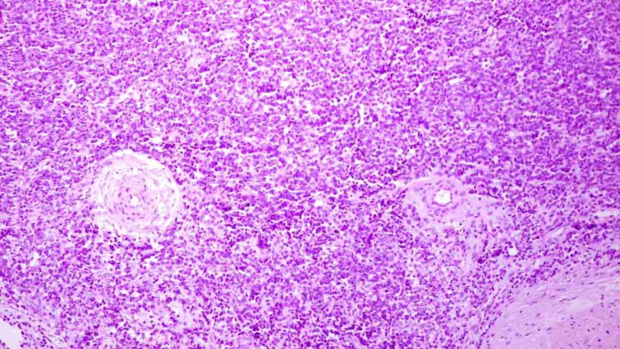 Alt text imagen: Células mesenquimales embrionarias humanas estudiadas para el Sarcoma de Ewing