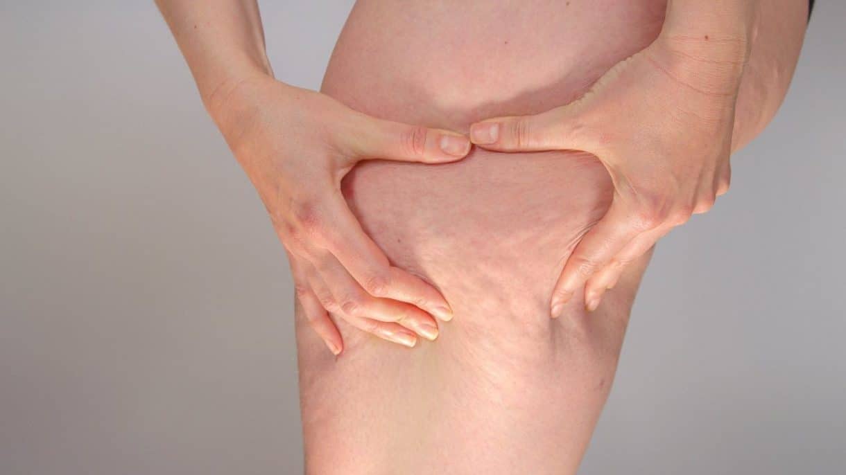 Mujer con acumulación de grasa en piernas característica del lipedema