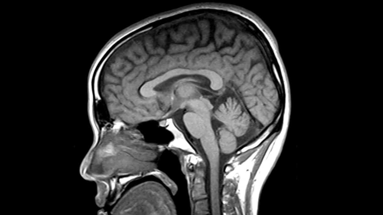 Imagen de resonancia magnética cerebral en parkinsonismos atípicos