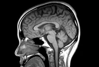 Imagen de resonancia magnética cerebral en parkinsonismos atípicos