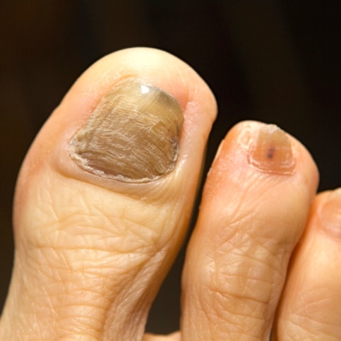 efectos de la quimioterapia