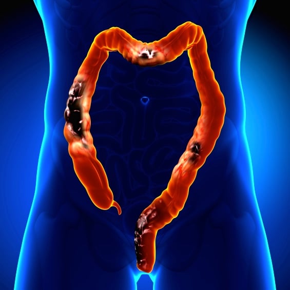 cáncer colorrectal