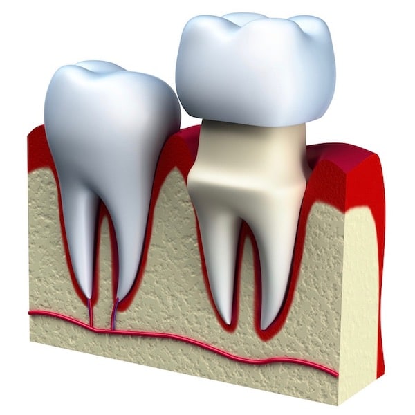 corona dental