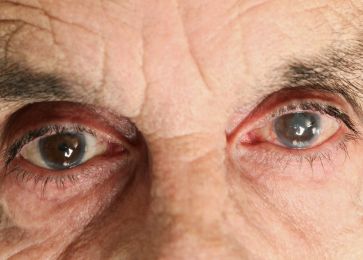 cataratas en los hombres