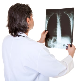 ¿Por qué desarrollan cáncer del pulmón las personas que no fuman?