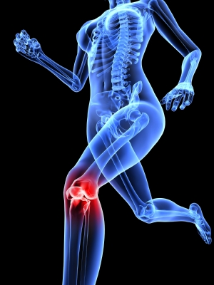 Las mujeres atletas tienen más riesgo de lesionarse el ligamento cruzado anterior (LCA)