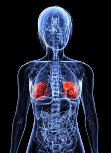 Se relaciona una proteína con la expansión del cáncer de mama al pulmón
