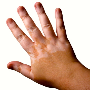 tratamiento del vitiligo