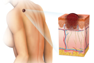Llega Zelboraf: una medicina nueva contra el melanoma, un cáncer de la piel