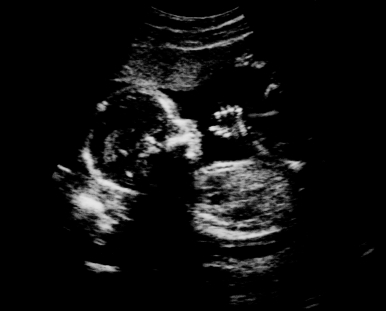La quimioterapia no le haría daño al bebé