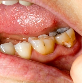 pericoronitis