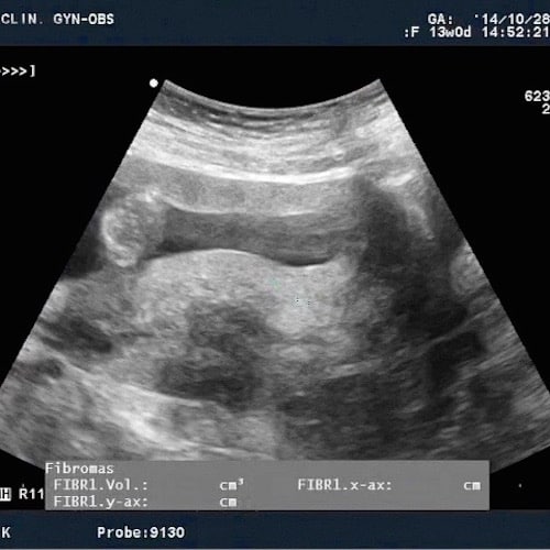 fibromas uterinos