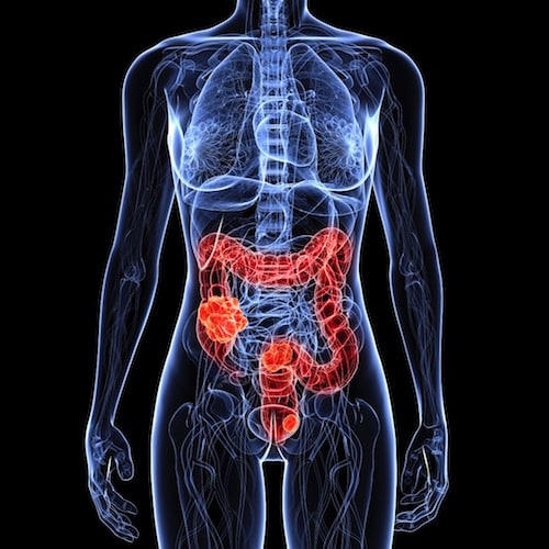 ¿Estás en riego de desarrollar cáncer colorrectal?