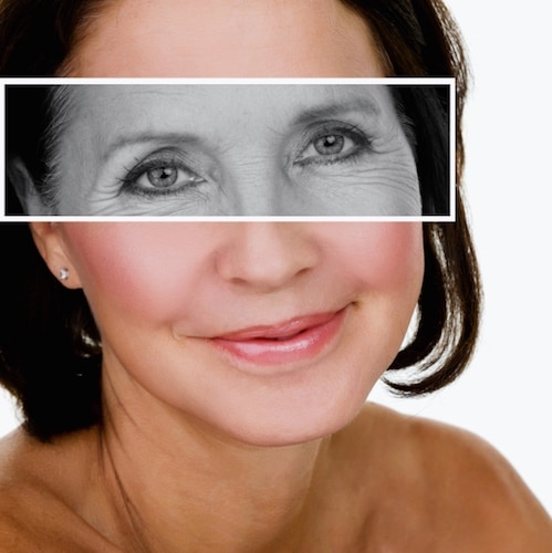 botox