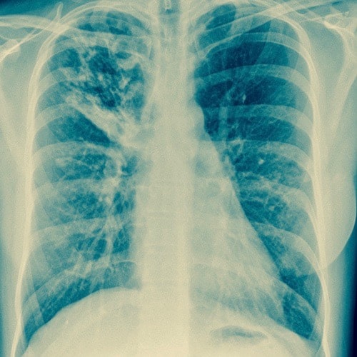 tuberculosis
