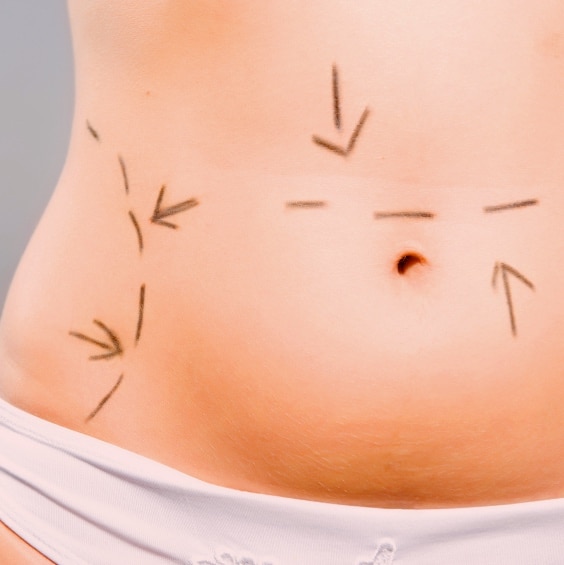 abdominoplastia