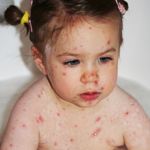 niña-pequeña-con-varisela