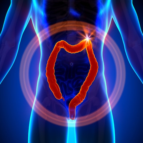 Detección temprana del cáncer de colon