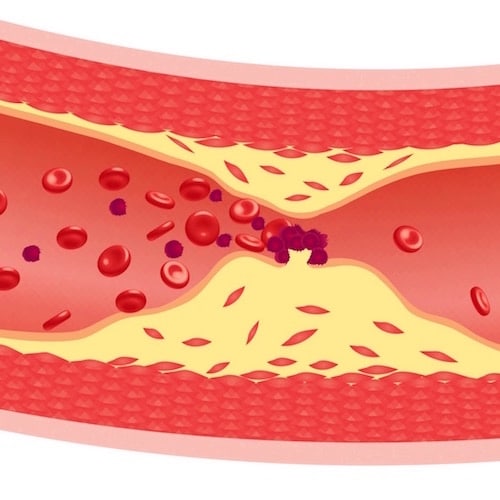 Hablando claro sobre la arterioesclerosis y la ateroesclerosis