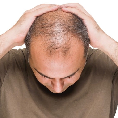¿Te estás quedando calvo? La calvicie puede ser un signo de otros problemas de salud